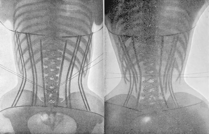 I Wore a (Medical) Corset for 5 Years. How do Victorian Corsets Compare? 