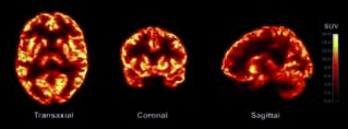 Brain Evidence Is Changing Criminal Trial Outcomes
