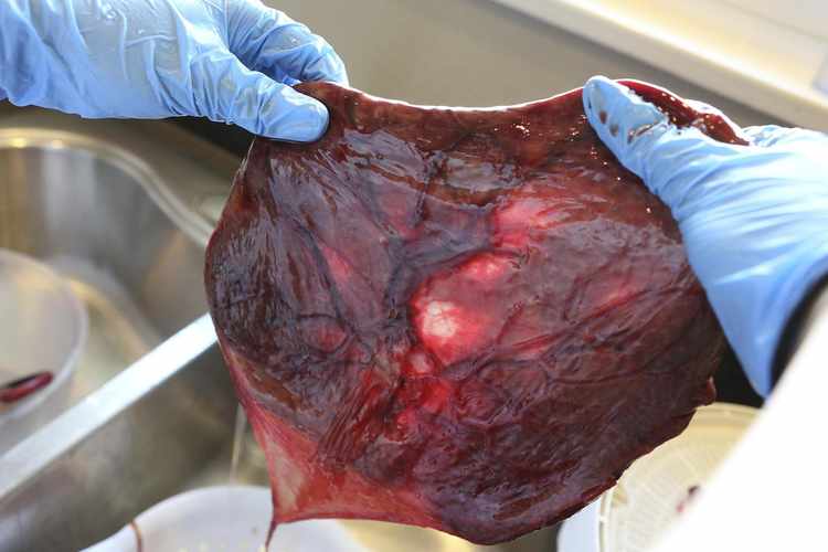 What the Placenta Can Teach Us About Cancer