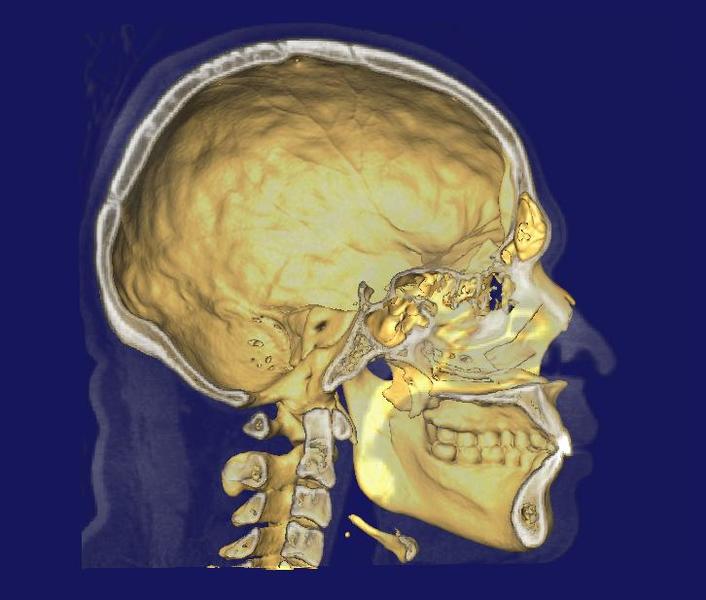 'Immune Organ' Inside Skull Directs Brain Defense