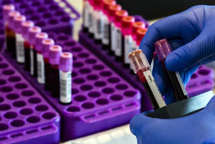 Blood Test Could Streamline Early Alzheimer's Detection