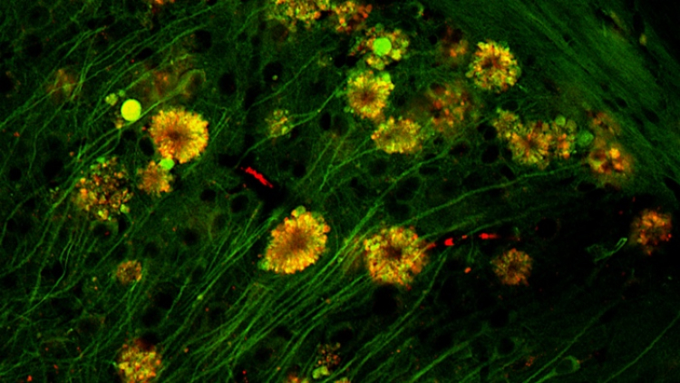 30 Percent of Adults With Alzheimer's Don't Get Dementia