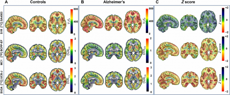 One Gene May Cause Over 90% of Alzheimer's Cases