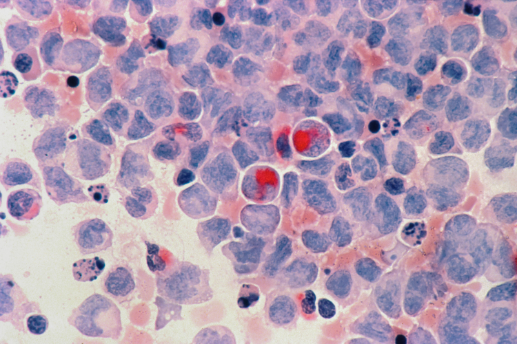 Experimental Drug Turns Cancer's Favorite Fuel Against It