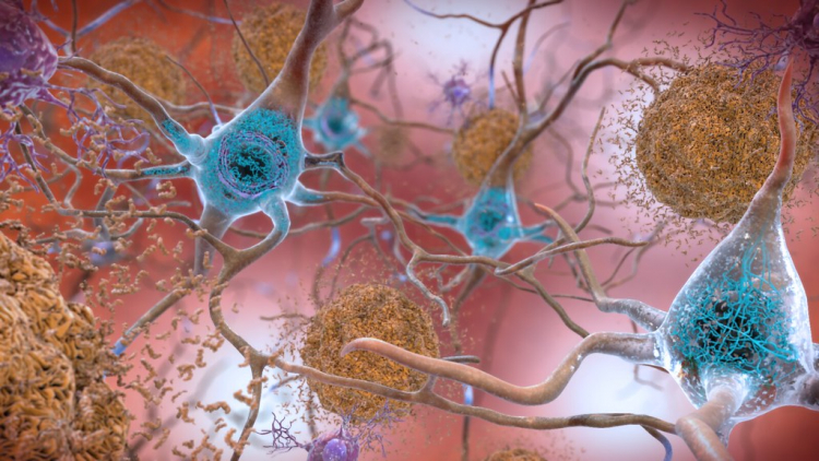 Brain Messenger Protein Drives Progression of Alzheimer's Disease