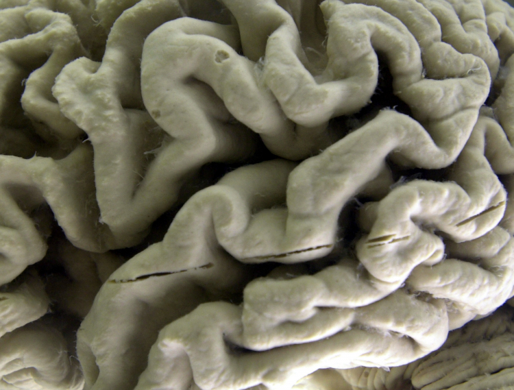 Is Alzheimers Disease Entering Its Prevention Era?