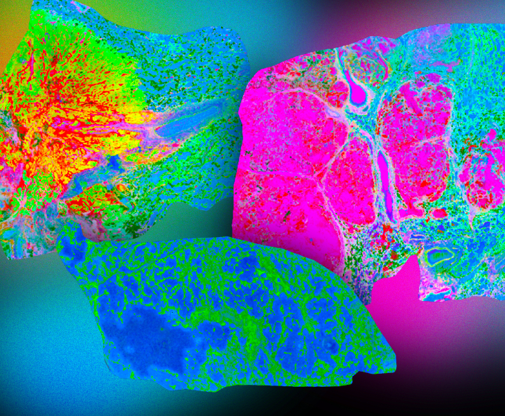 The Cancer-Alzheimer's Disease Paradox