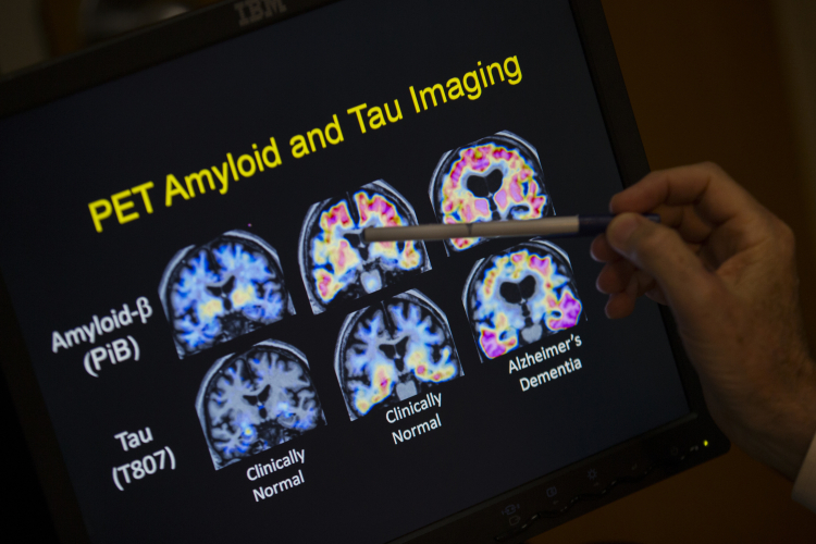 A Promising New Alzheimer's Therapy... Maybe