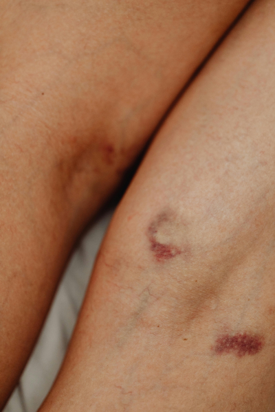 What Makes Bruises Change Color Over Time?