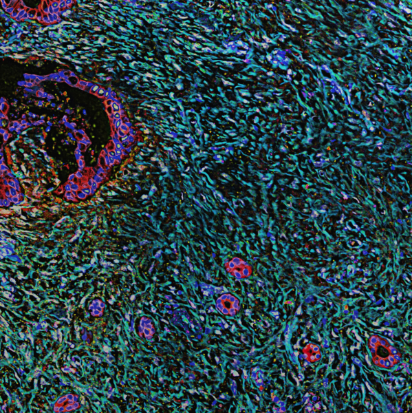 Chemotheraphy Gives Advantage to Certain Cells