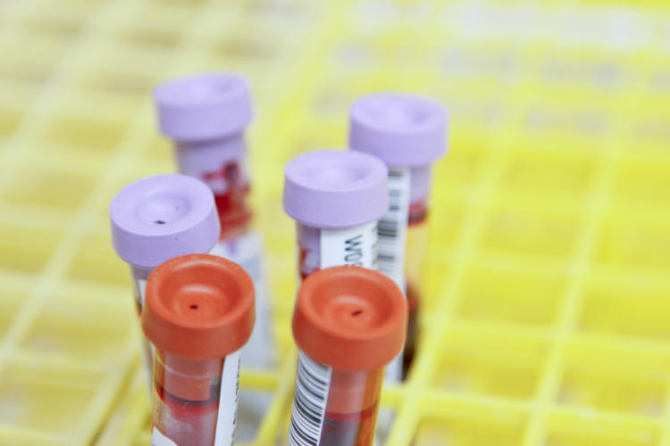 Blood Type Appears to Carry Higher Risk of Type 2 Diabetes