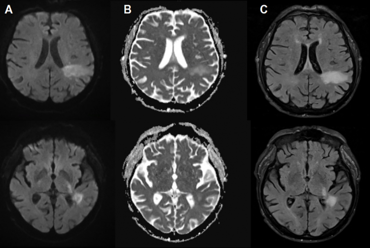 You're Likely Already Infected With a Brain-Eating Virus