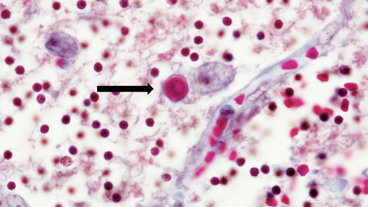 Amoebas Eat a Man Alive