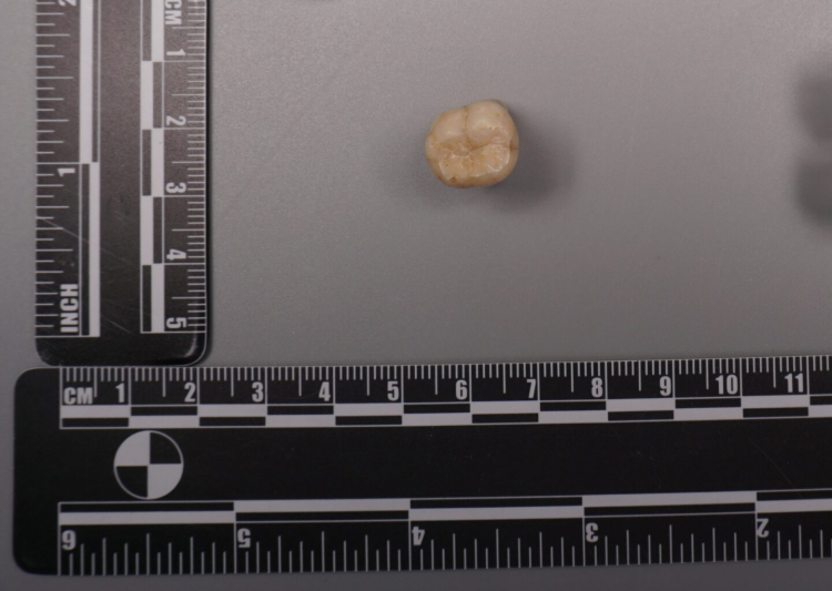 Teeth Suggest Denisovans Gave Us Some of Their DNA