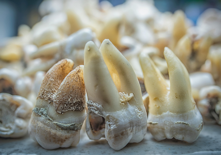 Drugs May Restore Stem Cells to Prevent Tooth Decay