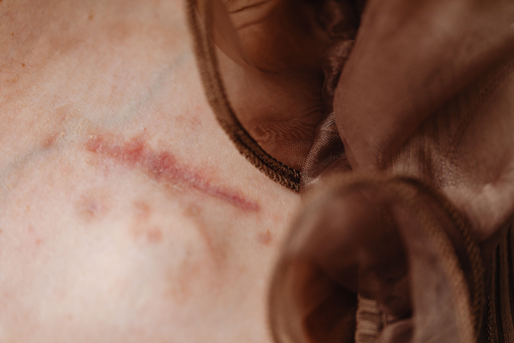 Nanomaterials Could Heal Stubborn Wounds