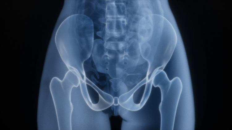 Woman's Hip Replacement Disintegrates