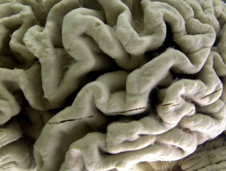 More Potential Alzheimer's Research Fraud